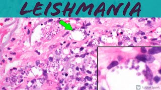 Leishmaniasis Leishmania Infection 5Minute Pathology Pearls ‪Dermatology Dermatopathology [upl. by Lena260]