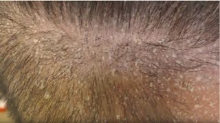 SCALP PSORIASIS FLAKING ALLOVER [upl. by Nniuqal375]