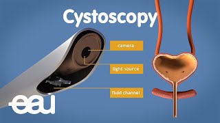 Cystoscopy overactive bladder [upl. by Akkin]