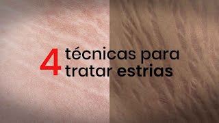 4 técnicas para tratar estrias [upl. by Deloria]