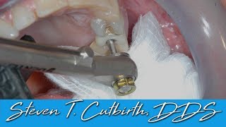 Loose Implant Screw  Dental Minute with Steven T Cutbirth DDS [upl. by Lemal476]