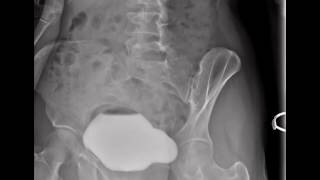 Normal Voiding Cystourethrogram VCUG [upl. by Donall]