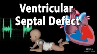 Ventricular Septal Defect Animation [upl. by Ariek]