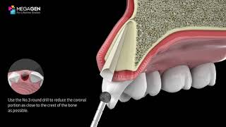 MegaGen PET Kit  Partial Extraction Therapy [upl. by Nirre]