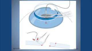 Corneal Abrasion Scratched Eye Symptoms Causes and Treatment [upl. by Ymarej]