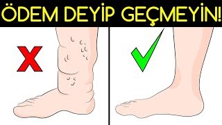 AYAK ÅÄ°ÅMESÄ° DEYÄ°P GEÃ‡MEYÄ°N Ã–NEMLÄ° BÄ°R HASTALIÄIN HABERCÄ°SÄ° OLABÄ°LÄ°R [upl. by Eutnoj]