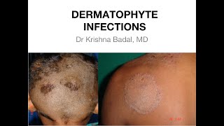 Dermatophyte infections of Skin [upl. by Koral]