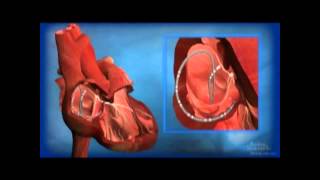 Ablation for AV Node Reentrant Tachycardia AVNRT [upl. by Buckels]