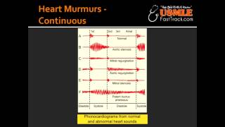 Heart Murmurs  Patent Ductus Arteriosus PDA [upl. by Kassandra]