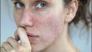 GET RID OF SKIN RASHES ON FACE  Allergic reaction [upl. by Suivart92]