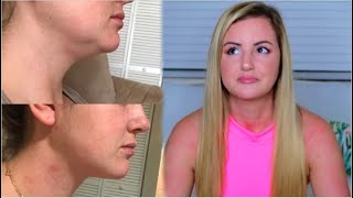 MY CHIN LIPO EXPERIENCE  COST PROCESS BEFORE amp AFTERS [upl. by Airrat73]