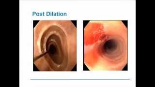 Eosinophilic Esophagitis [upl. by Odnumde]