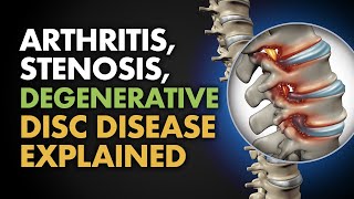 Arthritis Stenosis Degenerative Disc Disease Explained [upl. by Hannaj336]