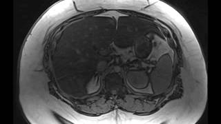 Hepatic Steatosis [upl. by Abelard201]