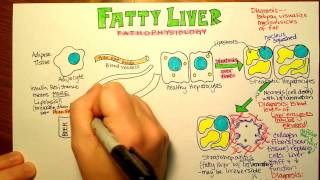 Fatty Liver Pathophysiology [upl. by Medardas]