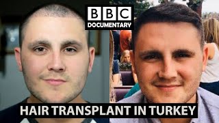 Hair Transplant Turkey  BBC Documentary  Paul Before amp After [upl. by Qidas]