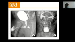 Colorectal Cancer Surgery principles and types [upl. by Yhcir381]