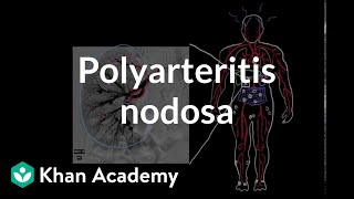 Polyarteritis nodosa  Circulatory System and Disease  NCLEXRN  Khan Academy [upl. by Sparhawk]