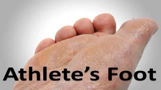 Athletes Foot Fungus Cure in 3 Minutes Simple Home Trick [upl. by Dusza937]