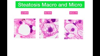 Macro and microvesicular steatosis in liver [upl. by Jsandye]