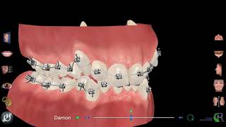 Traitement orthodontie avec bagues Dr Eric Ursat Strasbourg [upl. by Ardy]