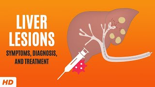 Liver Lesions Symptoms Diagnosis and Treatment [upl. by Aleusnoc]