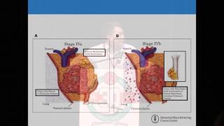 Huang Thymoma Thymic Carcinoma [upl. by Clance994]