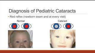 Pediatric Cataract [upl. by Eugor]