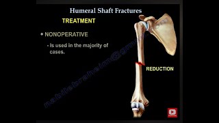 Humerus Fractures  Everything You Need To Know  Dr Nabil Ebraheim [upl. by Alia]