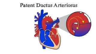 Patent Ductus Arteriosus PDA [upl. by Pippa109]