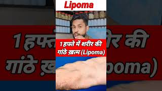 Lipoma Home Remedy AnsariHealthtips [upl. by Ahsik]