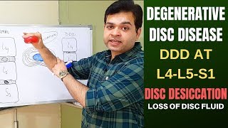 Disc Degeneration L5 S1 Disc Desiccation Disc Degeneration Causes DDDDegenerative Disc Treatment [upl. by Hctub]