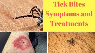 Tick Bites Symptoms and Treatments [upl. by Zimmermann]