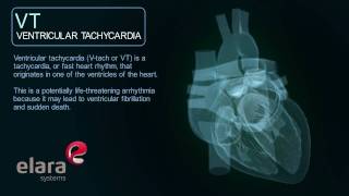 Ventricular Tachycardia Cardiac Arrhythmia 3D Animation [upl. by Bayly]