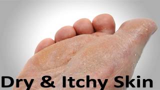 Athletes Foot Fungus Home Cure Try this trick just ONCE [upl. by Newo]