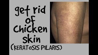 HOW TO GET RID OF CHICKEN SKIN KERATOSIS PILARIS DR DRAY [upl. by Assir373]