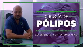 Pólipos Intestinais O Coloproctologista explica [upl. by Yrekaz845]