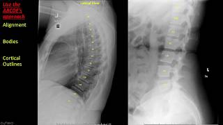 Introduction to Spine Radiographs [upl. by Kutzer]