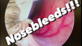 Nosebleeds epistaxis causes prevention treatments and more [upl. by Bodnar]