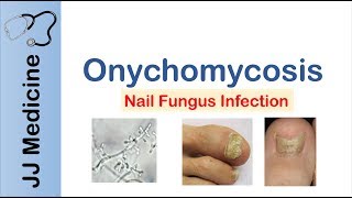 Onychomycosis  Nail Infection  Signs Symptoms Treatment [upl. by Konrad]