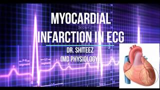 Myocardial Infarction MI ECG in HIndi [upl. by Rramel476]