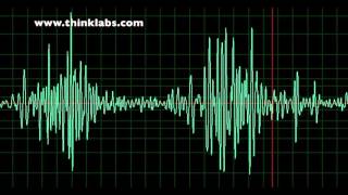 Patent Ductus Arteriosus slow [upl. by Helaina]