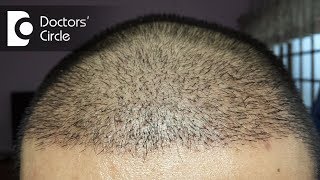 How long does it take for hair to grow after a hair transplant  Dr Madan Kumar BJ [upl. by Eizeerb15]