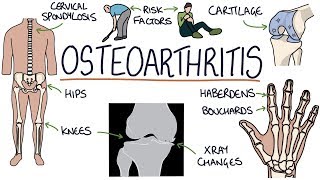 Understanding Osteoarthritis [upl. by Christiano]