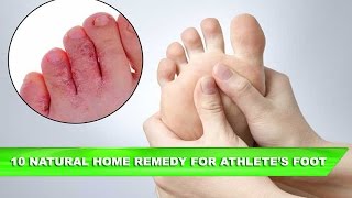 10 Natural Home Remedies for Athlete’s Foot [upl. by Brnaby]