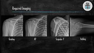 Proximal Humerus Fracture [upl. by Maribel]