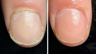 Harte verhornte Nagelhaut einfach ablösen 💁🤔💧 Essie Cuticle Peel vs Balsan [upl. by Tien]