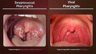 Streptococcal vs Viral Pharyngitis [upl. by Ciapha141]