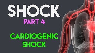 Cardiogenic Shock  Shock Part 4 [upl. by Nnaillek370]