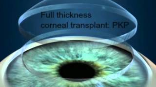 A CuttingEdge Treatment for Cornea Damage [upl. by Aim]